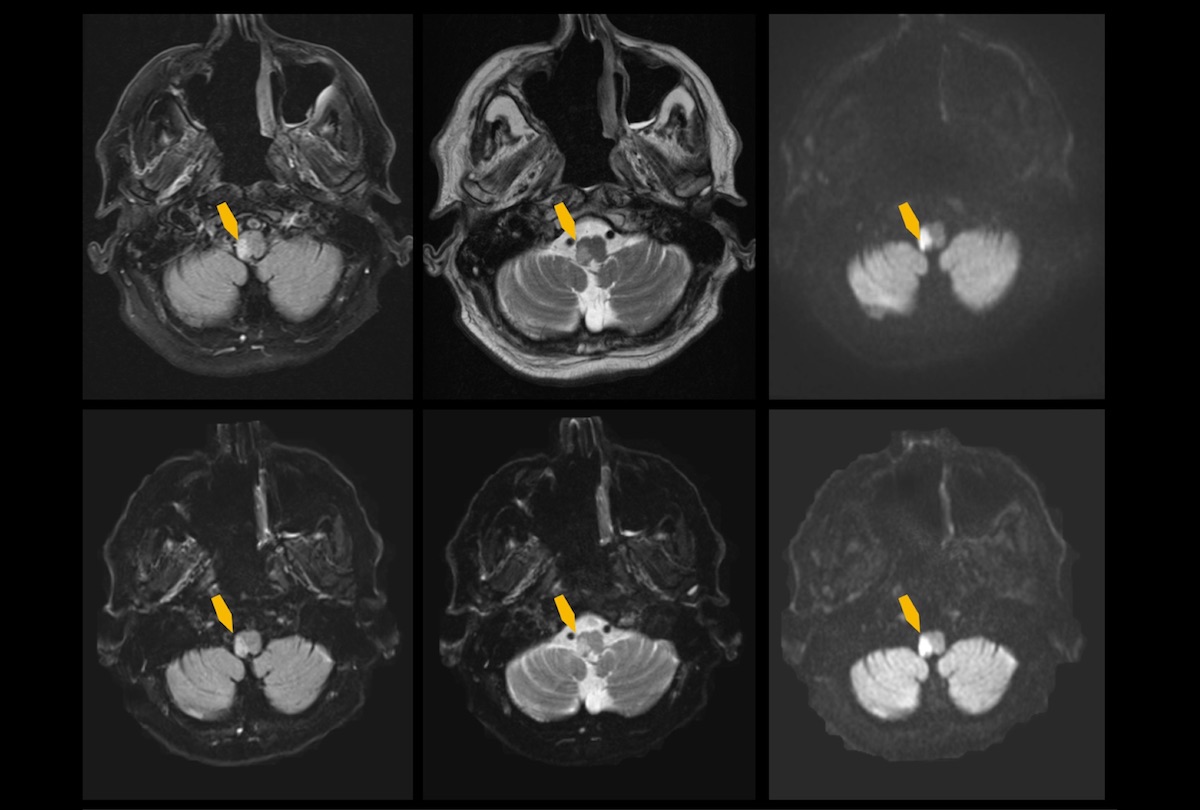 MRT-Aufnahmen des Gehirns einer Patientin mit einem akuten ischämischen Schlaganfall im Hirnstamm (gelbe Pfeile) mit der konventionellen (oben) im Vergleich zur KI-gestützten (unten) Methode und mit unterschiedlichen MRT-Sequenzen. (© Universitätsmedizin Mainz / S. Altmann)
