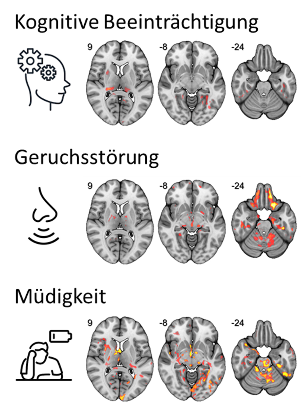 Nach einer Infektion mit COVID-19 besteht ein Zusammenhang zwischen einer veränderten Mikrostruktur in spezifischen Netzwerken des Gehirns mit kognitiven Beeinträchtigungen, Geruchsverlust und Fatigue. Je heller der Bereich, desto stärker der Zusammenhang (©Universitätsklinikum Freiburg, Nature Communications 2024)