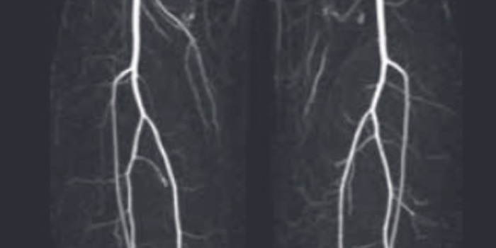 Ausschluss einer Stenose der Becken- und Bein-Arterien bei aorto-bifemoralem Bypass