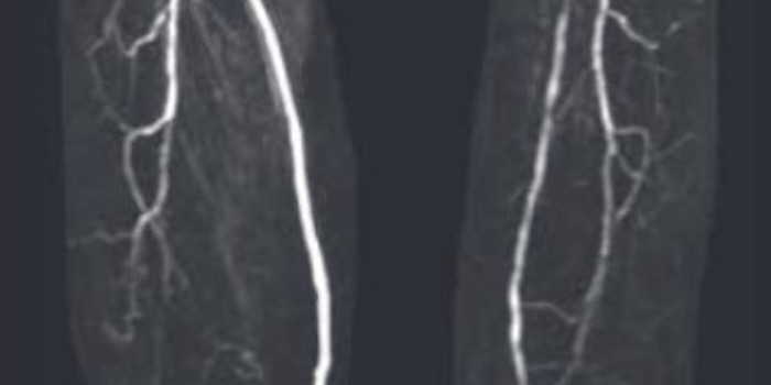 Stenose der rechten Beinarterie nach femoropoplitealen P3-Bypass