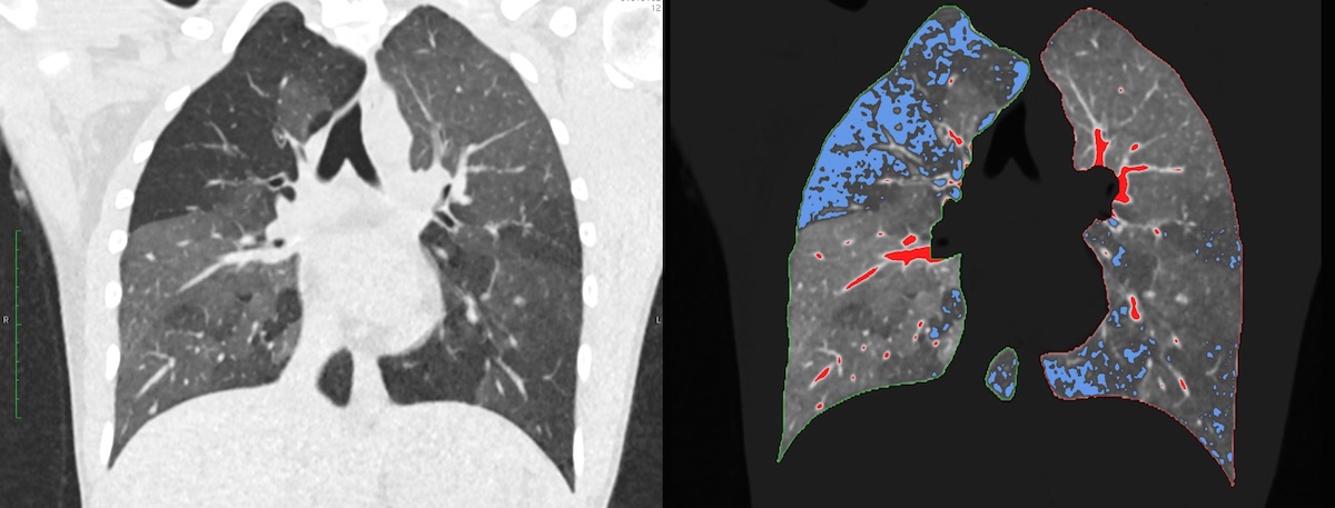 Links: Reguläres CT bei Verdacht auf COPD; rechts: darübergelegtes quantitatives CT. Die blauen Areale stellen das für die COPD typische „air trapping“ dar (©Universitätsmedizin Mannheim)