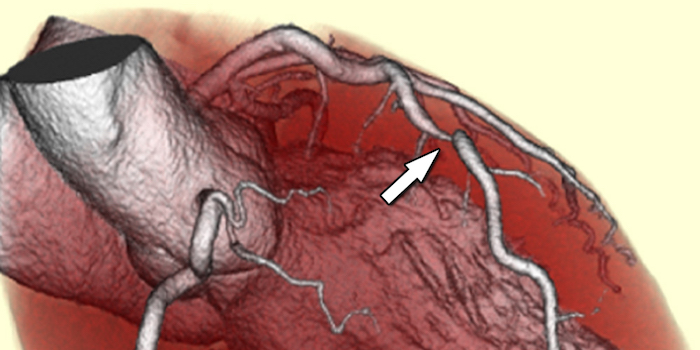 Oft genügt kardiale CT statt Herzkatheter