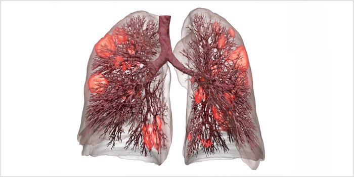 Künstliche Beatmung schonender durch digitales Lungenmodell