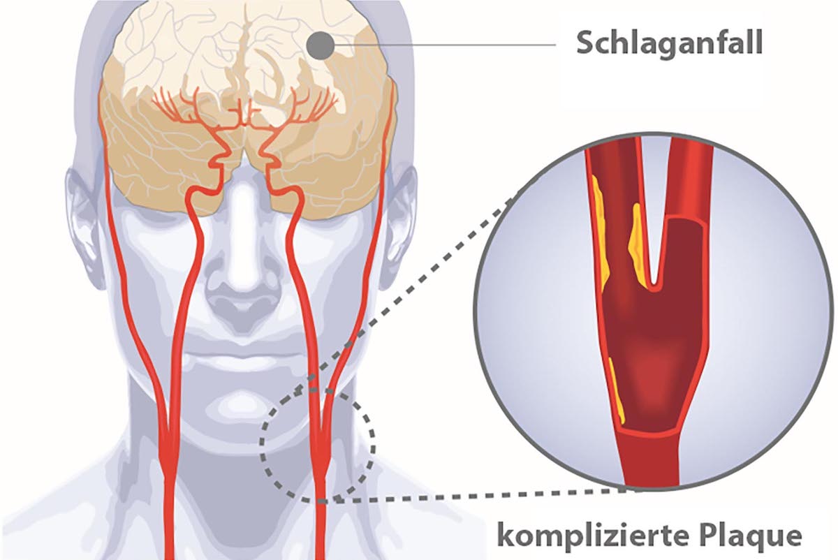 Gefährliche Plaques in der Halsschlagader (©LMU Klinikum München)