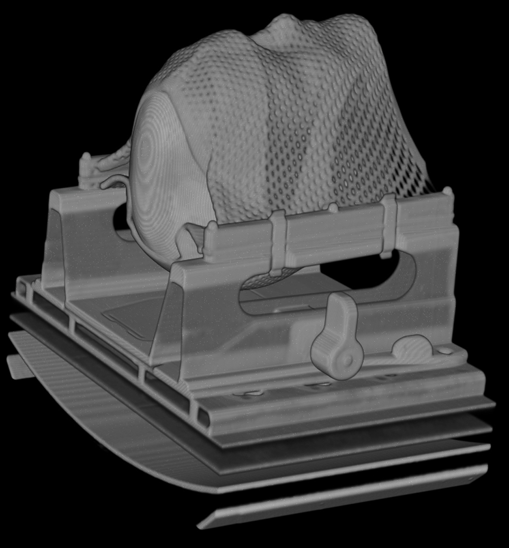 3D-gedruckter Schädel (CT-basiert) für einen individuellen Patientenplan (©Universitätsklinikum Freiburg)