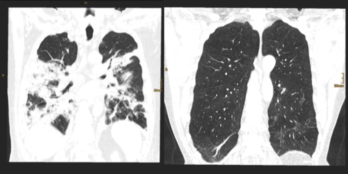 Neue radiologische Daten zu anhaltenden Lungenveränderungen nach CoViD-19