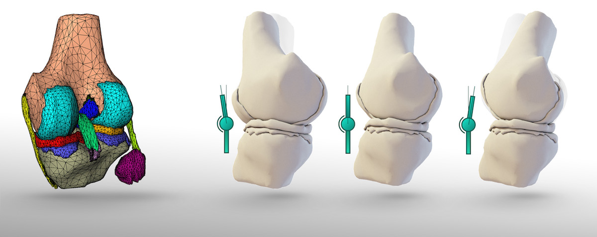 Ein Finite-Elemente-Simulationsmodell des Kniegelenks (links) ermöglicht die dynamische Vorhersage und Analyse verschiedener Gelenkstellungen wie Überstreckung, Ruhestellung, und 20° Beugung (MR-Datensatz Universitätsklinikum Freiburg; ©Fraunhofer MEVIS)