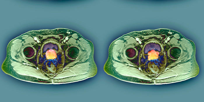 Verdacht auf Prostata-CA: Bei unauffälligem MRT geringes Krebsrisiko