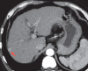 Chronische Leberzirrhose und hypervaskulärer Knoten im CT-Scan