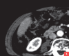 Hypervaskulärer Tumor im Lebersegment S4 in der Leber-CT