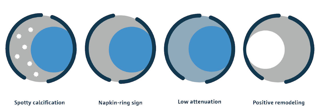 In der koronaren CT deuten bestimmte Erscheinungen auf ein hohes koronares Erkrankungsrisiko hin. Diese Anzeichen sind fleckige Verkalkungen, das Napkin-Ring-Zeichen, geringe Strahlungsabschwächung und positives Remodelling.